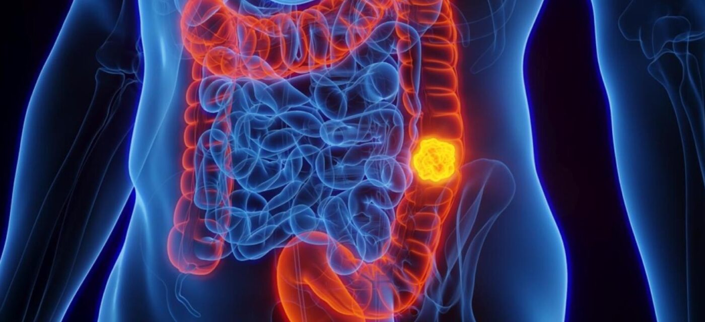 В мире наблюдается тревожный рост заболеваемости колоректальным раком среди людей моложе 50 лет