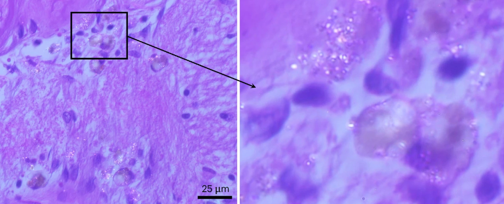 Учёные обнаружили микропластик в мозге, но его влияние на здоровье пока неясно